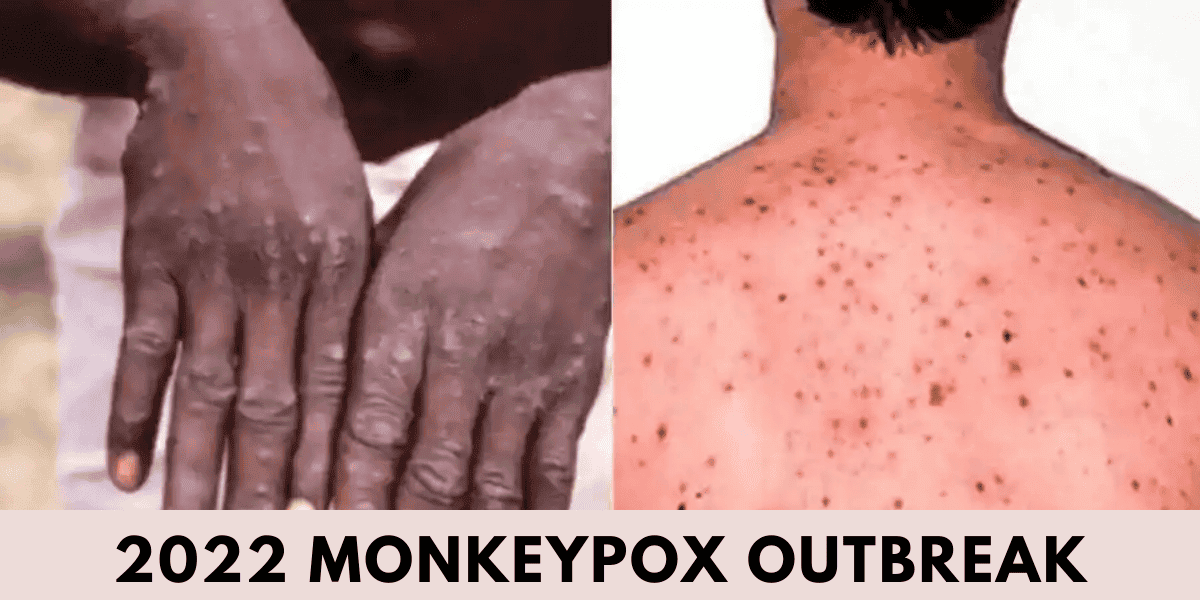 2022 Monkeypox Outbreak