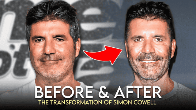 simon cowell plastic surgery