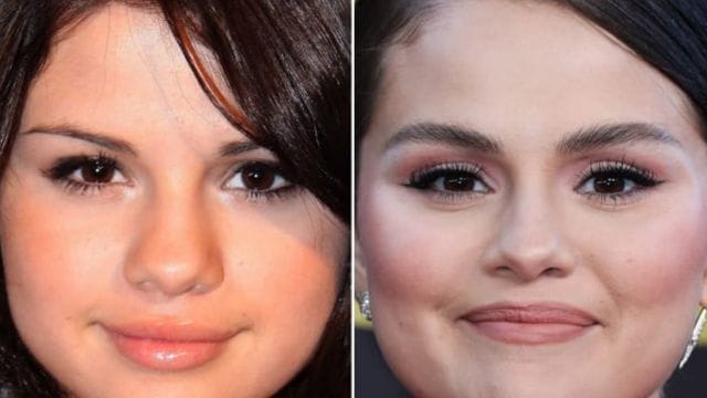 Eyelid Surgery Celebrity Blepharoplasty Before and After