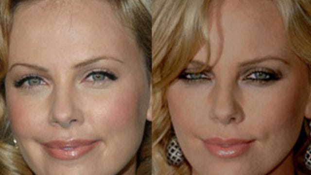 Eyelid Surgery Celebrity Blepharoplasty Before and After